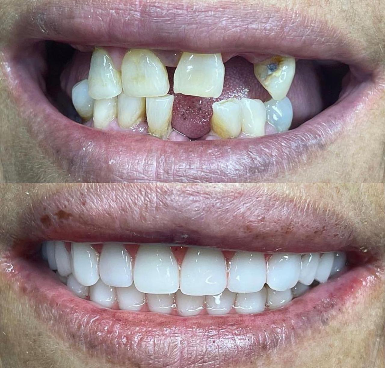 Antes e depois — Protocolo Dentário