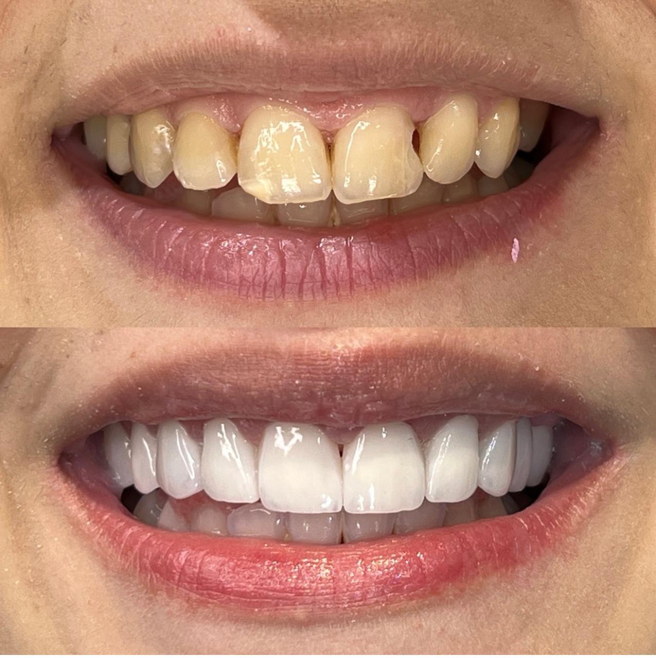 Transformação real — Facetas em porcelana na Vitta Odonto